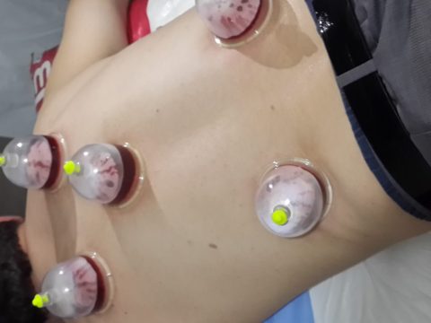 Sırta Yapılan Hacamat